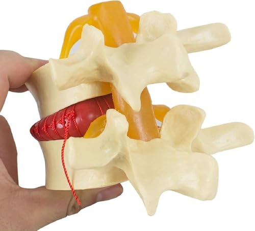 Demonstrationsmodell for Bandscheibenvorfälle in der Lendenwirbelsäule, anatomisches Modell der menschlichen Wirbelsäule, Modell for degenerative Erkrankungen der Lendenwirbelsäule, 1,5-faches Lehrmod